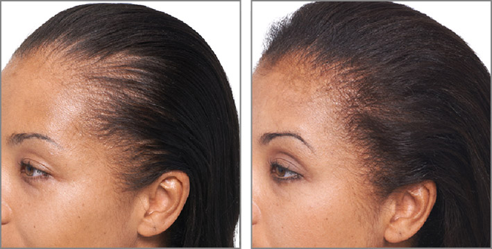 Keranique Hair Regrowth Treatment Review